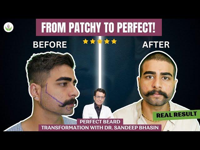 Beard Transplant Success Story | Happy Patient’s Journey at Care Well Medical Centre