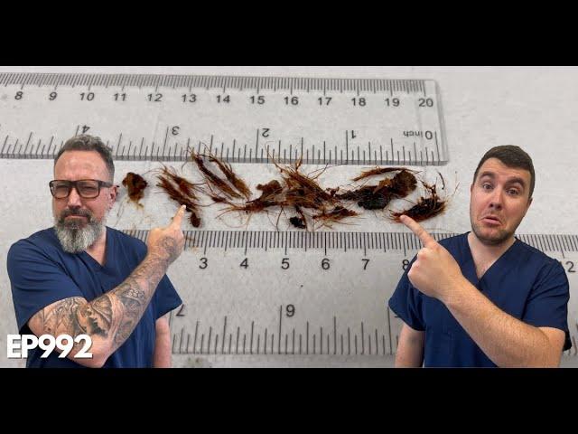 INSANE Amount Of Hair Removed From My Ear Canal - EP992