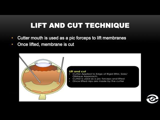 Lift and Cut Cutter Delamination | Diabetic Vitrectomy Technique | Dr. Veer Singh