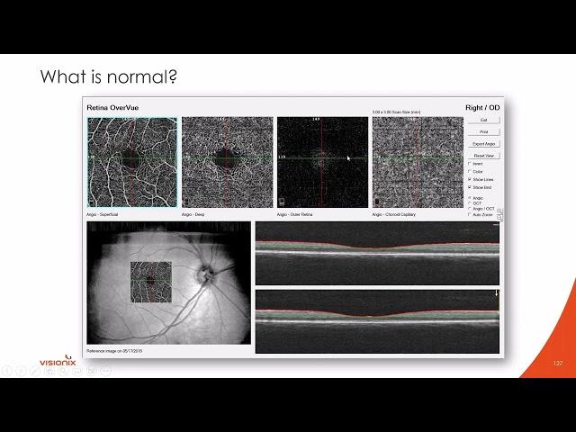 Interpreting Retinal OCTs & Introducing OCT-Angiography, Part 2 with Dr. Nathan Lighthizer