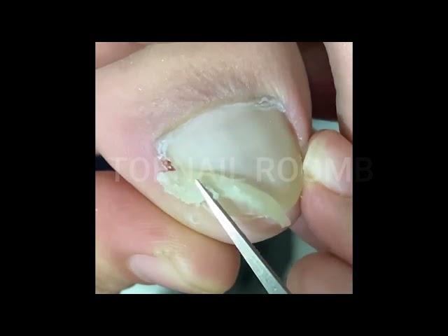 The Big Ingrown Toenail Treatment Tutorial #tonailroomb