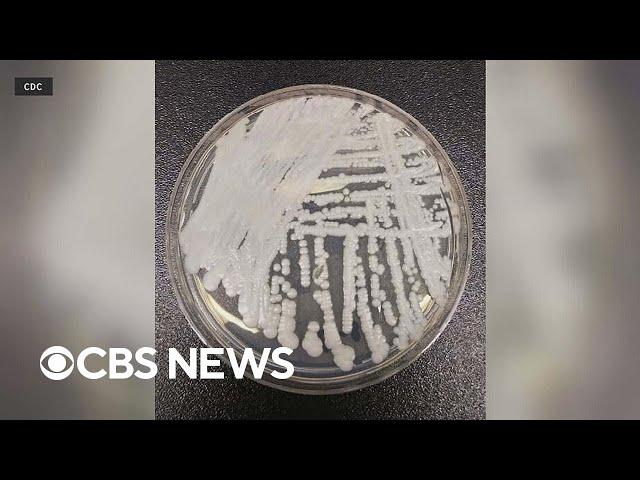 CDC issues warning about a fungus called Candida auris