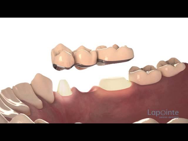Types de ponts  - Centres dentaires Lapointe