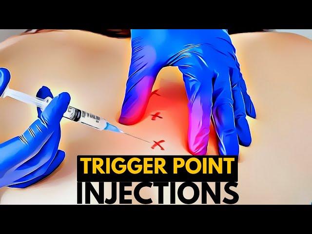 The Anatomy of Pain Relief: A Look at Trigger Point Injections