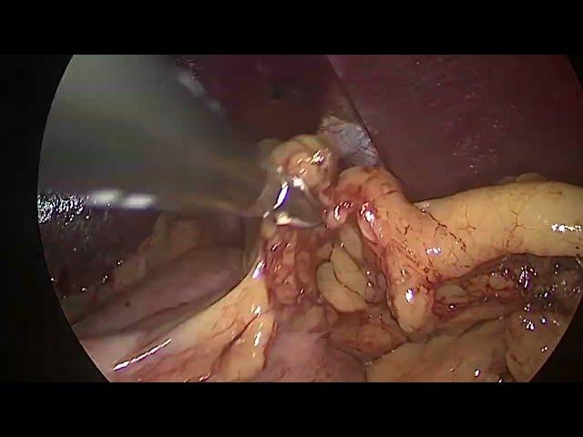 Laparoscopic fundoplication surgery; for /Hiatus hernia/‘heartburn surgery’ and ‘reflux operation’