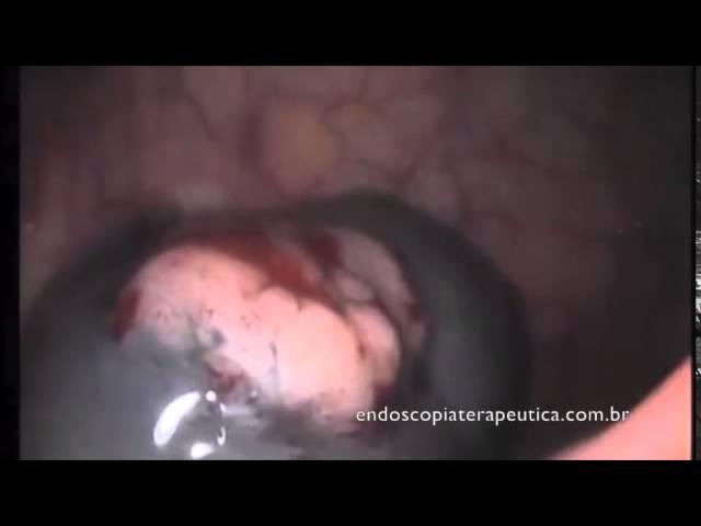 MUCOSECTOMY OF SIGMOIDE LST