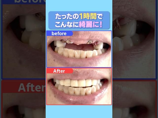 1時間でこんなに綺麗に！？ It looks so beautiful in just one hour!  #歯医者 #仮歯  #ザホワイトデンタルクリニック #治療