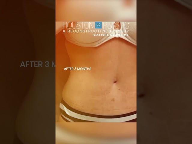 Tummy tuck after 80 pound weight loss #tummytucksurgery #cosmeticsurgery #plasticsurgery #weightloss