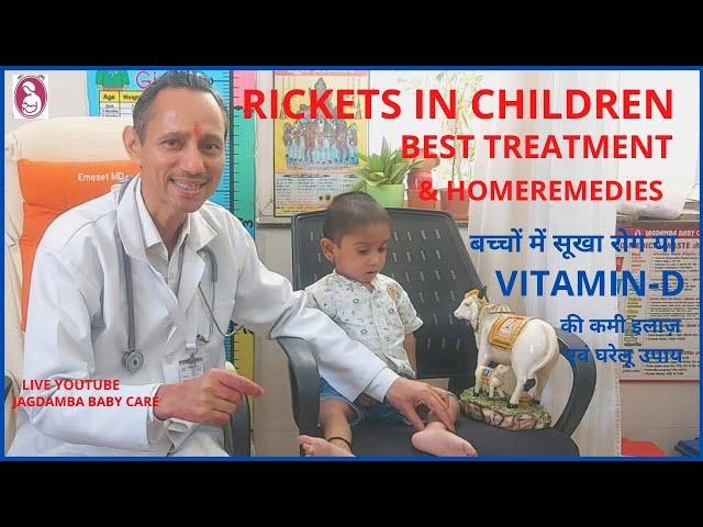 RICKETS IN CHILDREN BEST TREATMENT & HOMEREMEDIES,बच्चों में सूखा रोग VITAMIN -D की कमी इलाज़ नुस्खे