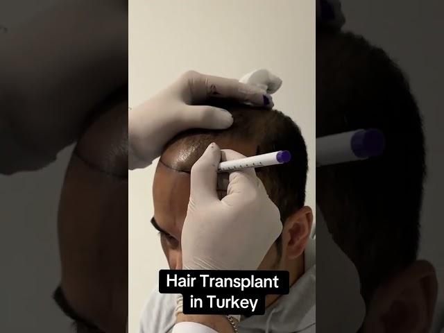 Hair Transplant in Turkey | Hair Transplant Process  #hairtransplantturkey