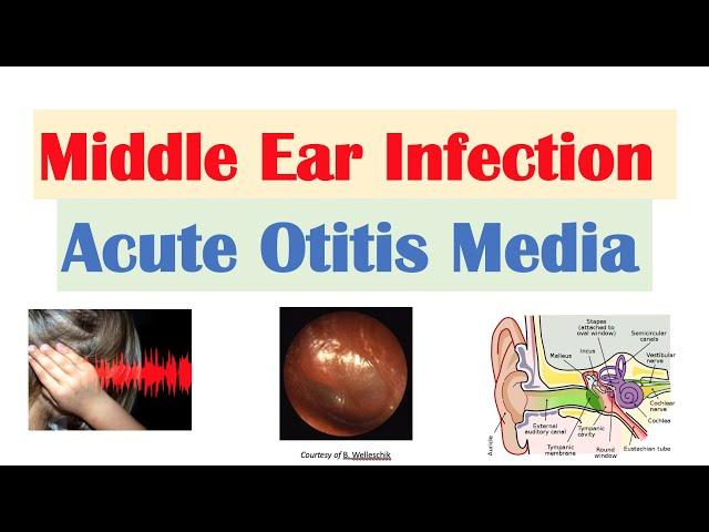 Middle Ear Infection (Acute Otitis Media) | Causes, Symptoms, Diagnosis, Treatment