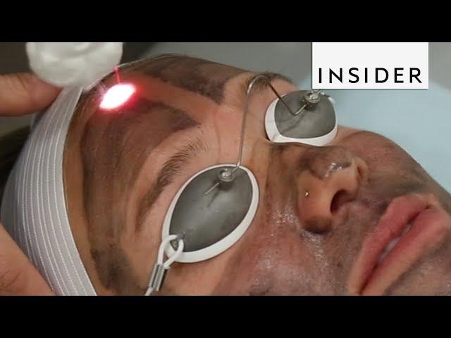 Get Glowing Skin With A Laser Facial