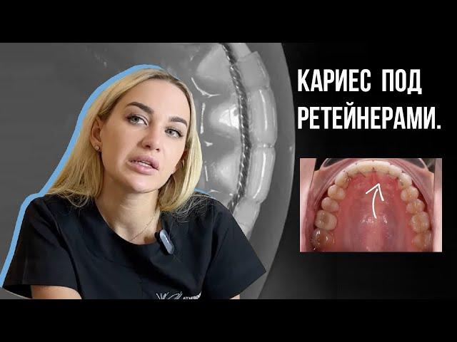 Кариес под ретейнерами после снятия брекетов️