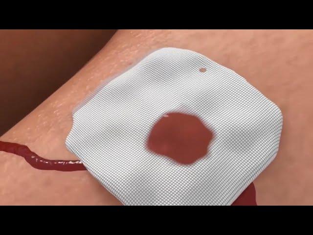 BloodSTOP® iX Advanced Hemostat with WoundHEAL® Promo Video | SOUTHERN CRESCENT