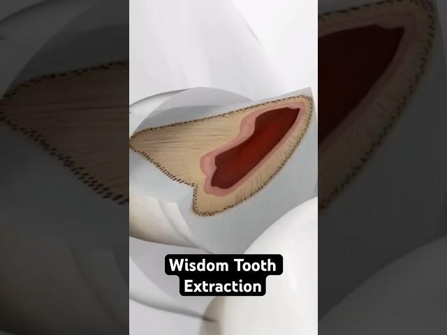 Wisdom Tooth Extraction (3D Animation)