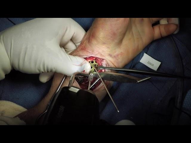 Distal Radius ORIF with Lever Action Plate System® and IntelliSense Drill