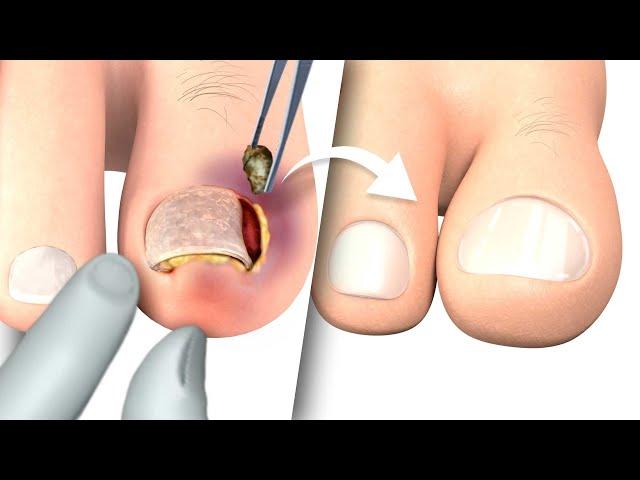 Ingrown toenail removal Treatment | Step by step