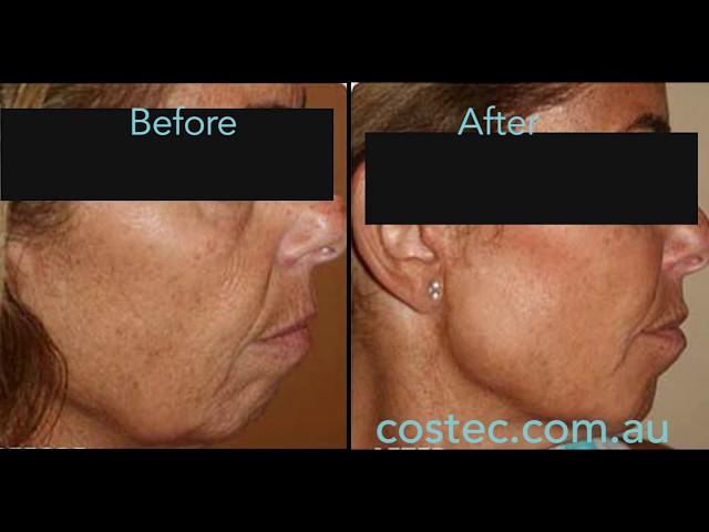 HIFU™ treatment - Before & After pictures for Face Lift and Skin Tightening