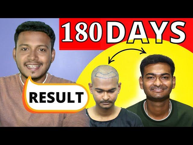 Understanding Hair Transplant Results ll 6 Months Experience With 2700 GRFATS