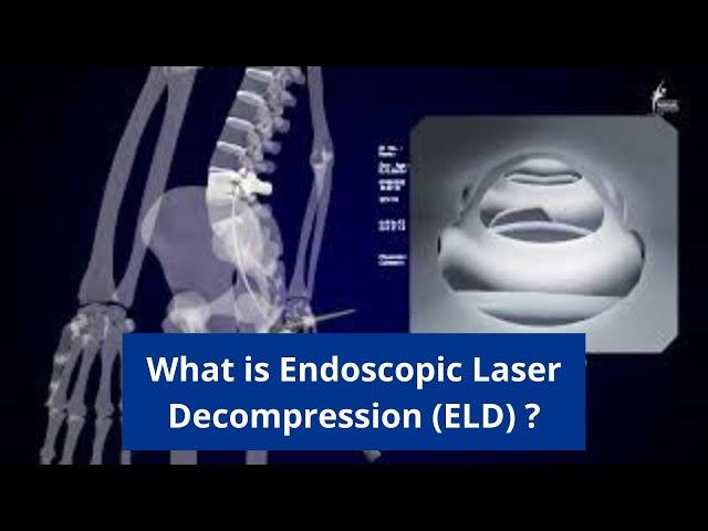 Endoscopic Laser Decompression (ELD) - Minimally Invasive Treatment for back and neck pain