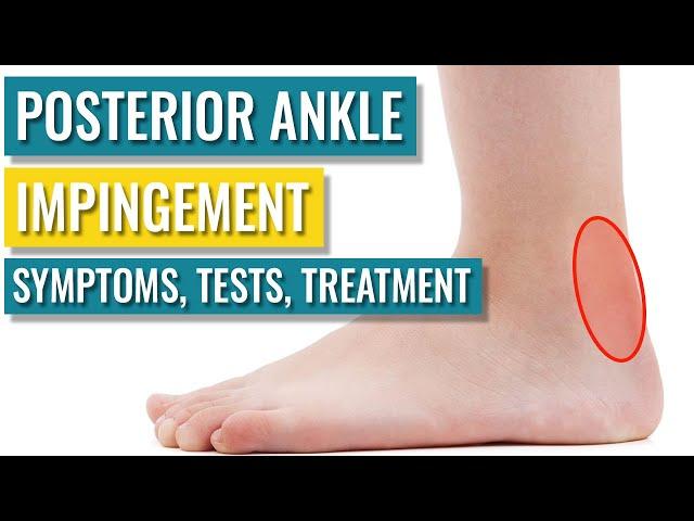 Posterior Ankle Impingement - Symptoms, Diagnosis, Treatment & Recovery Time