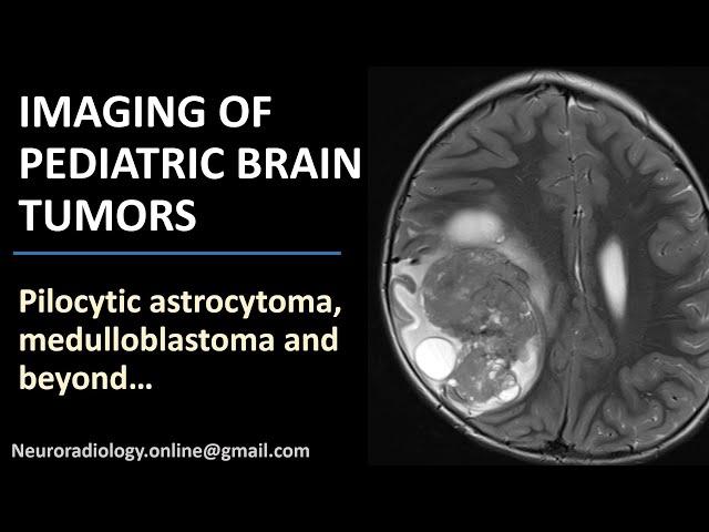 Imaging of Pediatric Brain Tumors