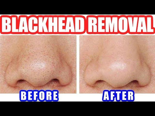 How to Remove Blackheads: Best Blackhead Removal Easy Tool