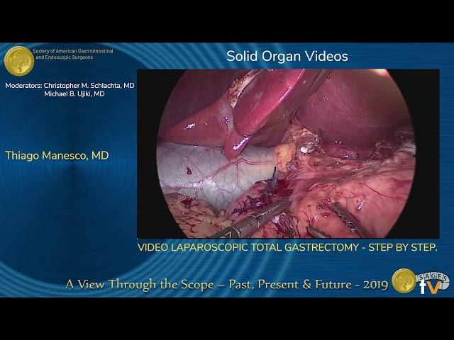 VIDEO LAPAROSCOPIC TOTAL GASTRECTOMY - STEP BY STEP