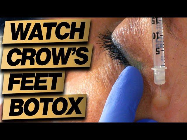 Botox Eyes Crows Feet Treatment Technique: 2 Easy Steps