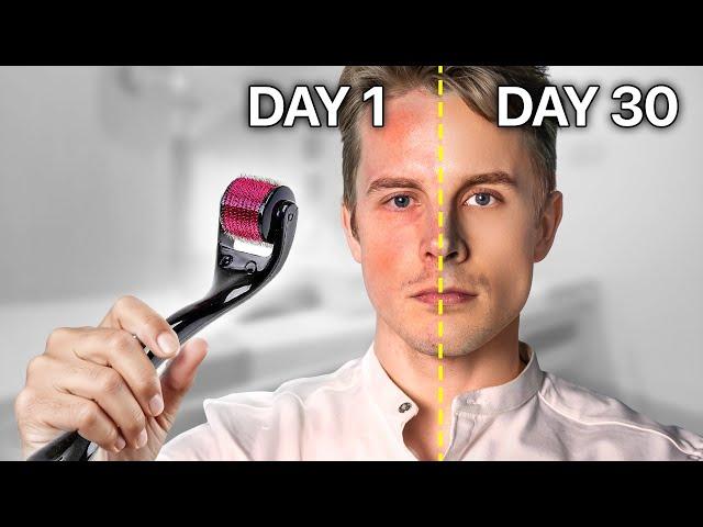 Everything You Need to Know About Microneedling for Great Skin