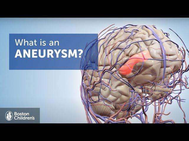 Brain Aneurysms | Boston Children's Hospital