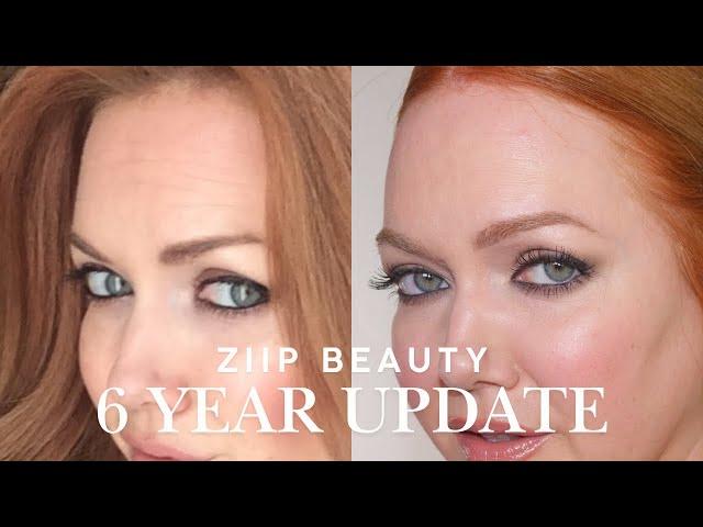 Before + After | Six Years of Using ZIIP Beauty Halo + Exclusive Discount Code