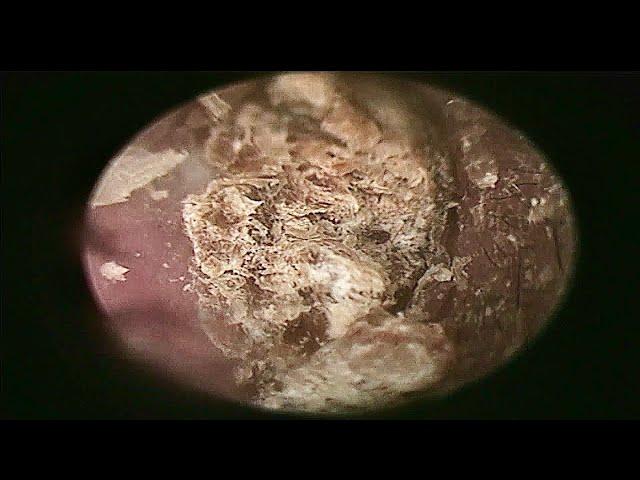 Blocked Earwax Removal | Doctor Anh