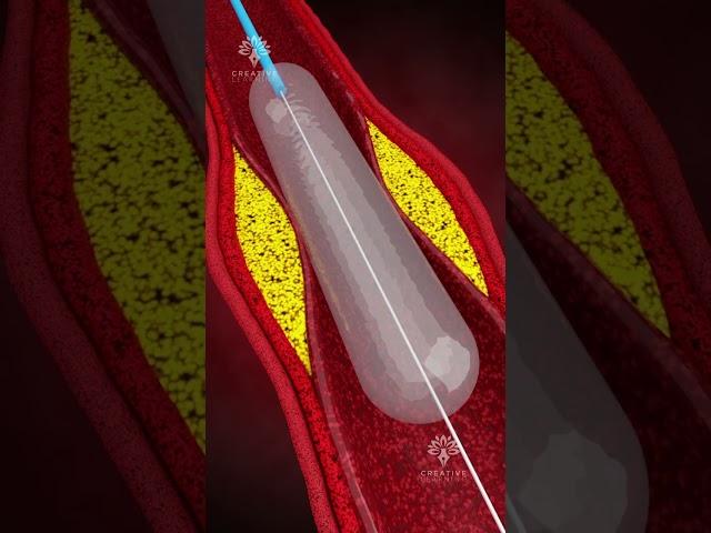 How Does Coronary Angioplasty Work | Blocked Arteries Treatment #shorts - creativelearning3d