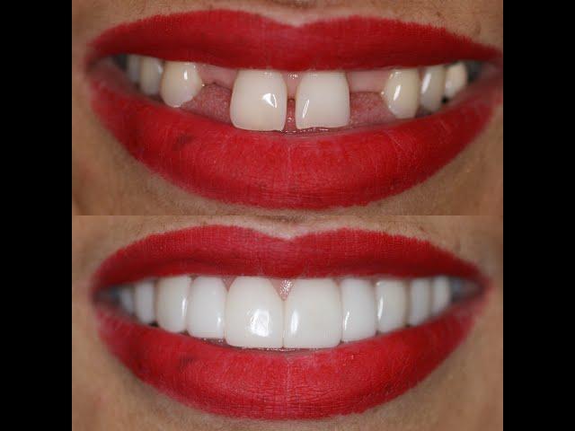 Houston Cosmetic Dentist...Cosmetic options from A to Z....$$$$$ to $...We can fit your Budget!