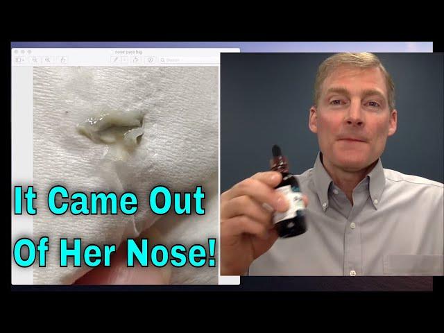 Horrific and Amazing! Parasites Coming out of Nose!