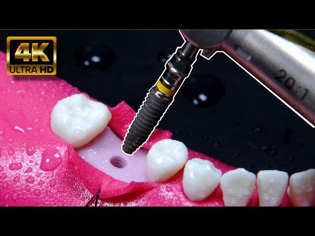 AWESOME dental implant process in 4K