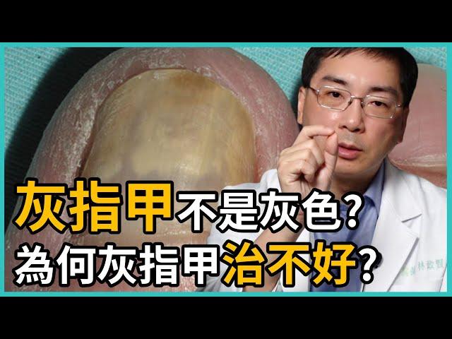 灰指甲不是灰色的嗎？還有其他顏色嗎？為何灰指甲一直治不好？讓皮膚科林政賢醫師一一點破治療灰指甲的NG行為吧！