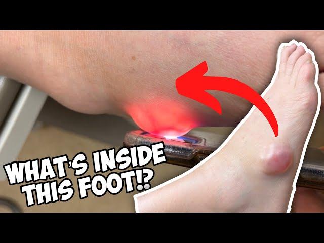 Look what was in this foot?!  Dr. Nick Campitelli