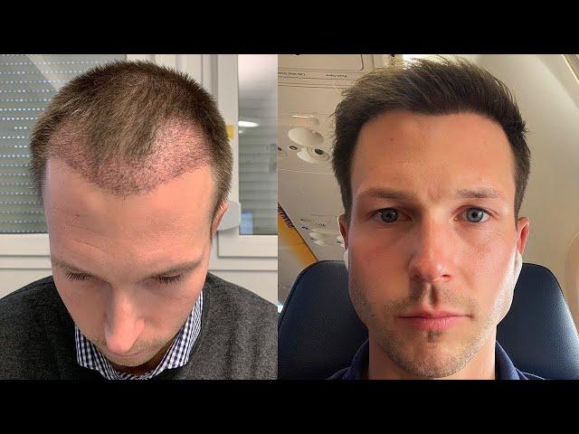 How Much Does A Hair Transplant Cost?