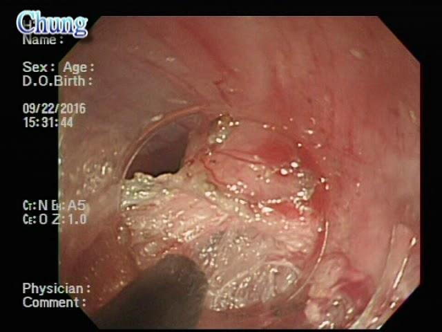 POEM for esophageal achalasia