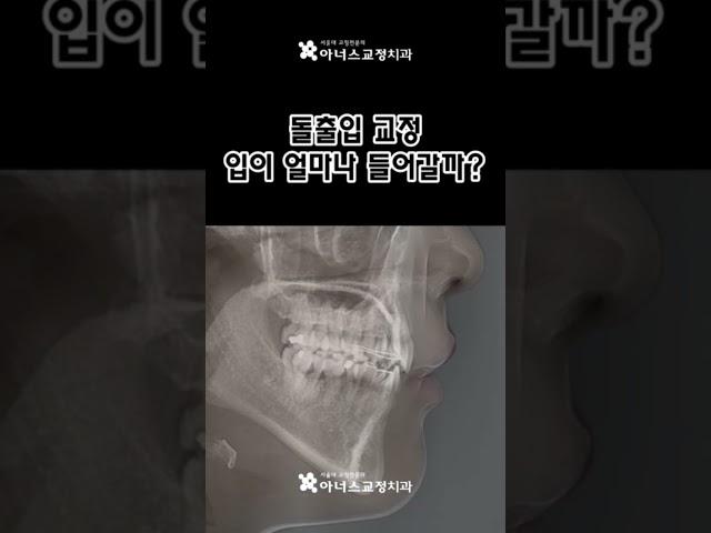 튀어나온 돌출입 교정하면 얼마나 달라질까?