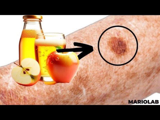 Apple Cider Vinegar Will Remove Age Skin Spots if You Do This...