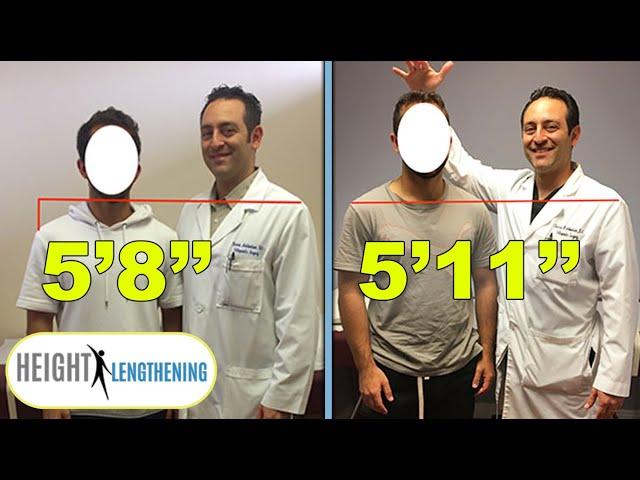 Man Gains 3 Inches in Height After Height Lengthening Procedure | #Shorts