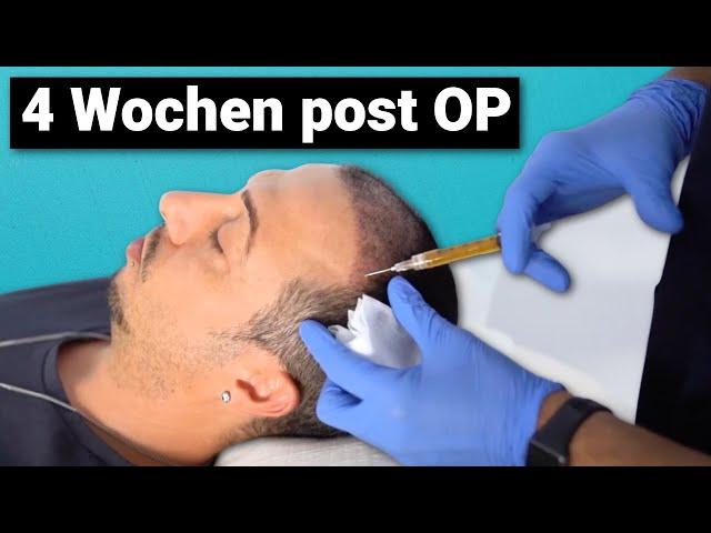 PRP Therapie 4 Wochen nach der Haartransplantation in Deutschland | Update und Erfahrung