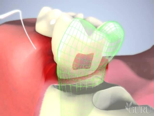 Poche parondontale et furcation - Centres dentaires Lapointe