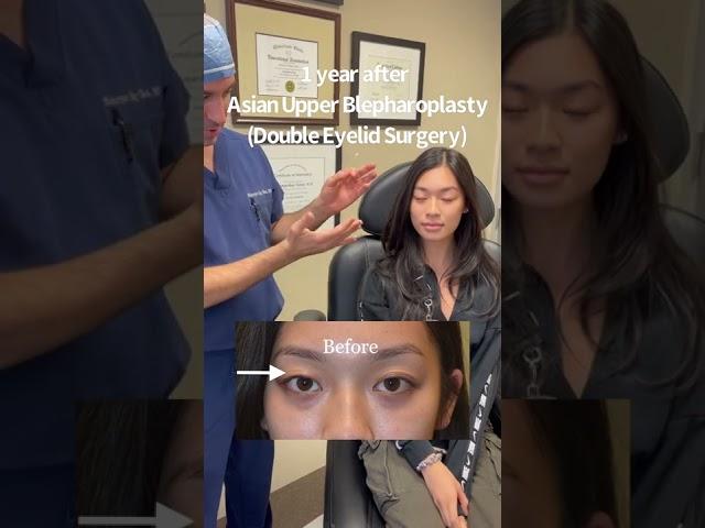 Double Eyelid Surgery by Dr. Taban