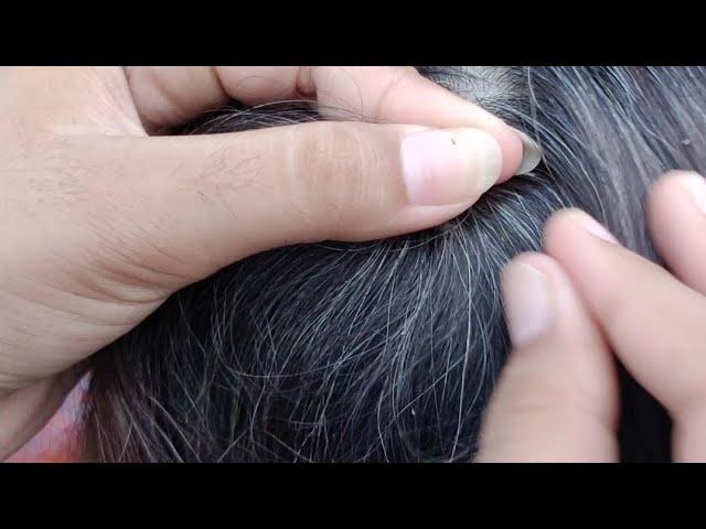 old lady hairs full of lices removal of thousands of lices by hans#ASMRSajida