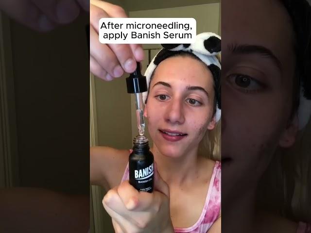 This is why microneedling and vitamin C are great for your acne scars #acnescars #acne #skincare