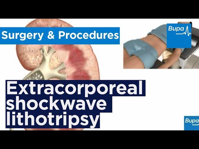 How extracorporeal shockwave lithotripsy is used to treat kidney stones | Bupa Health